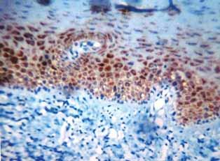 squamous cell carcinoma, (D) moderately differentiated squamous cell carcinoma, (E) poorly