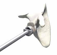 Glenoid Bone Graft & Baseplate Fixation The baseplate and bone graft construct is impacted into the central drill hole.
