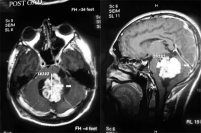 Figure 3 Fig. 3 MRI Brain Post Gad the whole tumor.