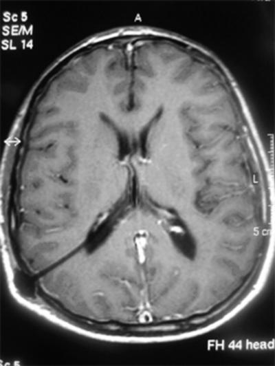 5 Day 1 - Post-Op CT-Brain Plain A pre-operative diagnosis of Choroid Plexus Papilloma / Ependymoma was made and