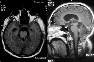 There are few case reports in the literature: (1) spinal accessory schwannoma mimicking a tumor of the fourth ventricle,(2) midline cerebellar cystic schwannoma, (3) a schwannoma arising from the