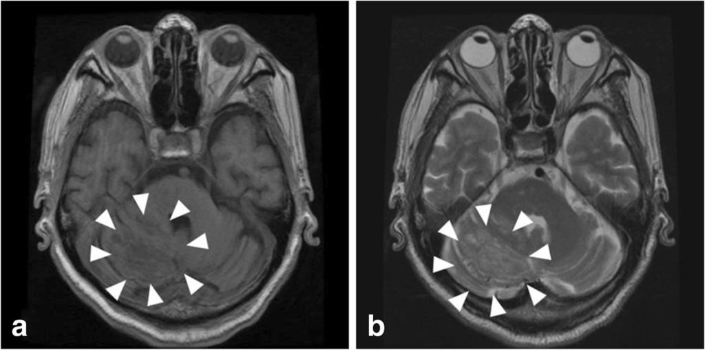 Mtsumoto et l. Dignostic Pthology (2015) 10:172 Pge 2 of 5 Fig. 1 MRI findings in cereellr dysplstic gngliocytom. T1 () nd T2 () weighted mgnetic resonnce imges of the hed.