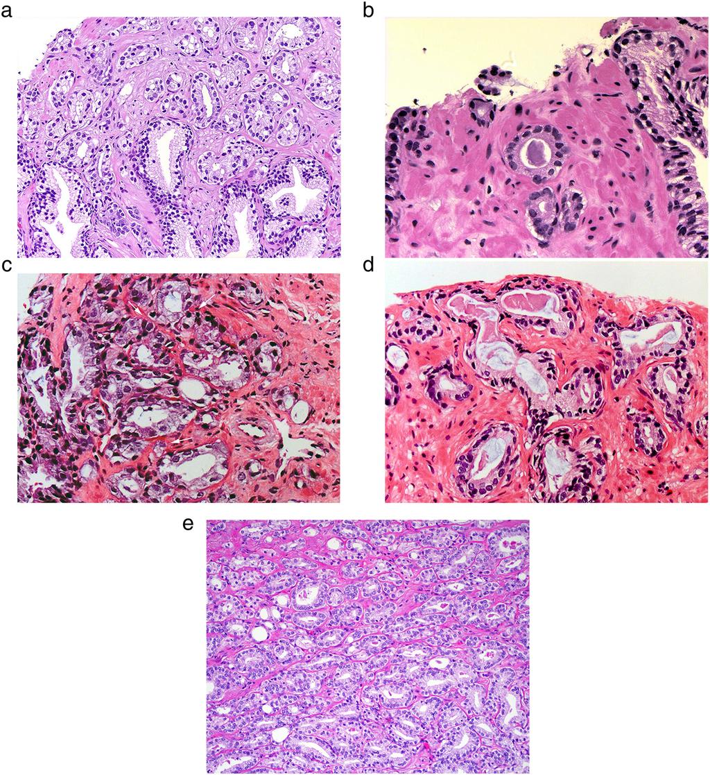 262 R. B. Shah and M. Zhou Figure 2 Gleason pattern 3 prostate cancers. (a) Variably sized discrete glands infiltrating between benign glands represent classical Gleason pattern 3.