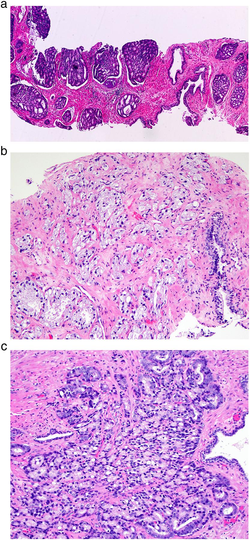 Advances in prostate cancer pathology Figure 3 Gleason pattern 4 prostate cancers. (a) All cribriform carcinomas regardless of size and shape are considered to be pattern 4.