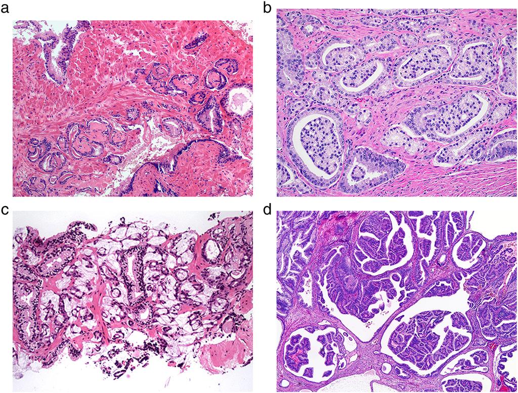 266 R. B. Shah and M. Zhou Figure 6 Prostate cancer with variant morphology. (a) Cancer glands with mucinous fibroplasia.