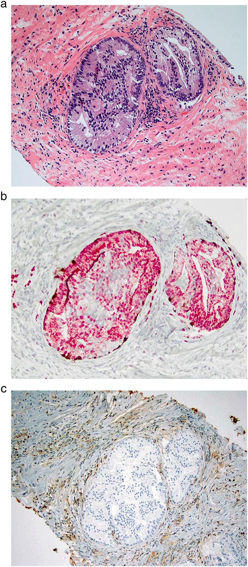 268 R. B. Shah and M. Zhou Reporting of tertiary pattern 5 in the biopsy and prostatectomy specimens Prostate cancer often contains >2 Gleason patterns within the same tumor.