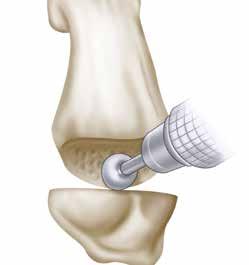 The prepared cup should be approximately 1/3 the size of the Implant Sizer and maintain a residual cortical rim of bone.