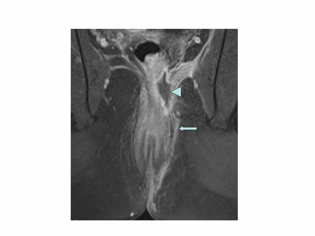 Fig. 5: Coronal fat suppressed contrast enhanced T1 weighted MR image shows a left perianal