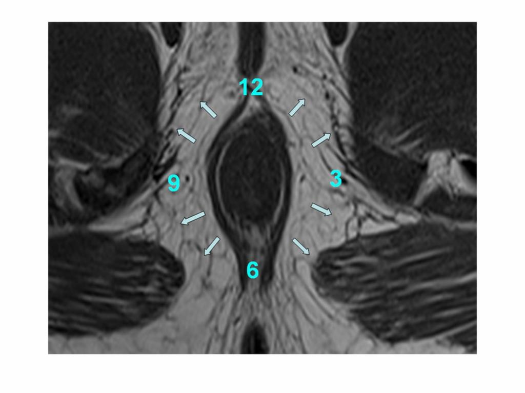 Fig. 6: Axial T2-weighted MR image shows the anal clock, for referencing