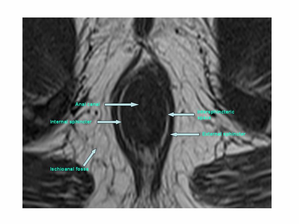 Fig. 2: Axial T2 weighted image at the level of mid anal