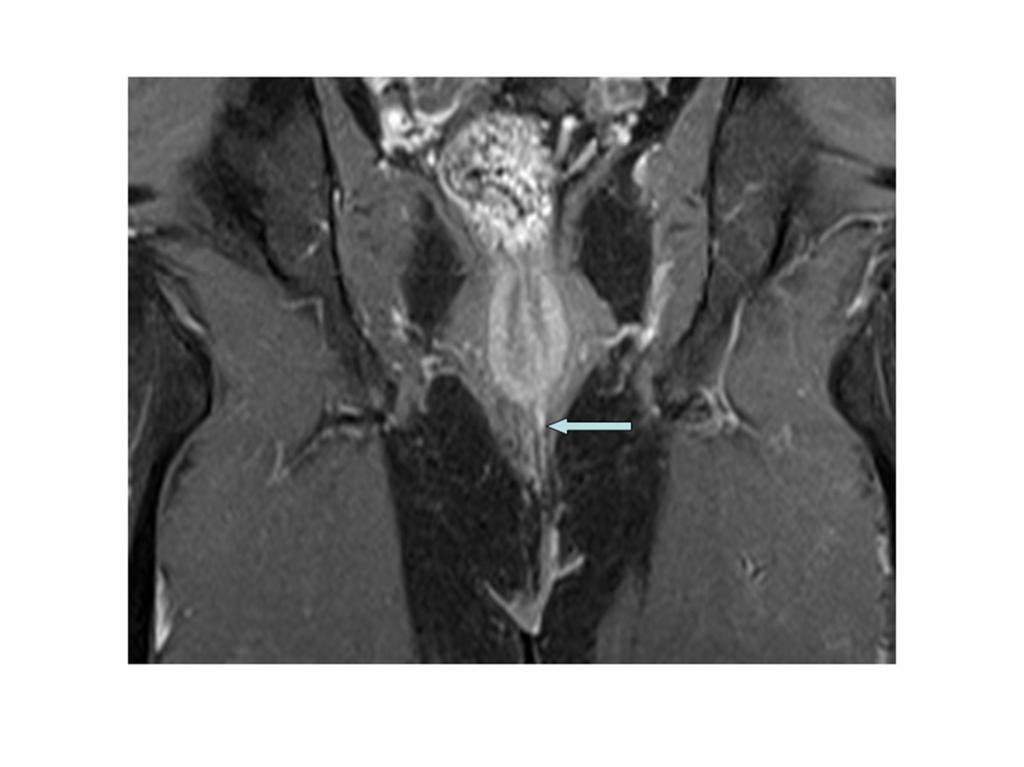 Fig. 3: contrast-enhanced fat-suppressed T1-weighted MR image shows an enhancing intersphincteric