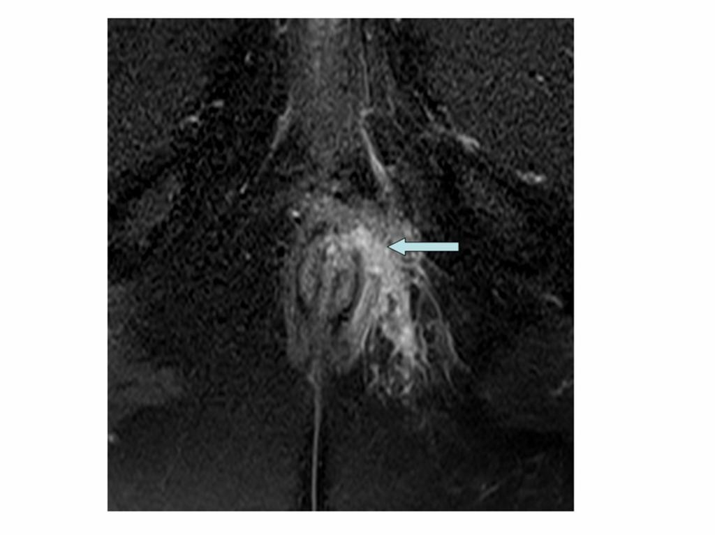 Fig. 4: Axial contrast-enhanced fat-suppressed T1-weighted MR image shows a transsphincteric fistula (arrow)