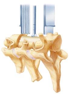 Distraction of the intervertebral space is achieved by the graft s advancement through the ramps (Figure 4).