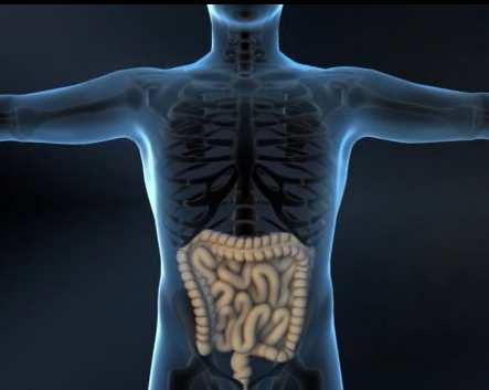 Perianal Fistulas A common severe complication of Crohn s disease