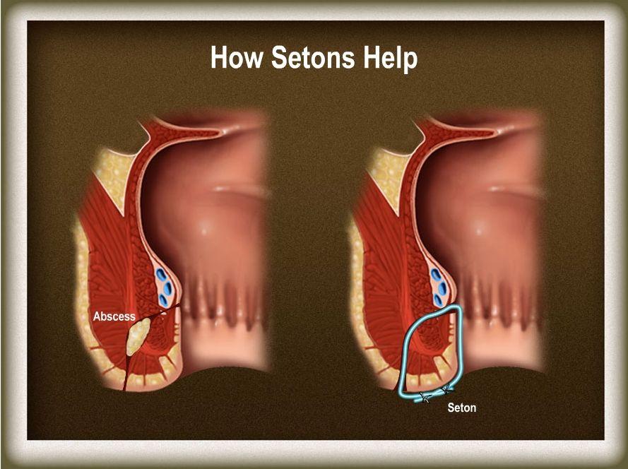 Other Surgical Options for Fistulas Cutting Seton Diverting Ileostomy Does not alter course of disease Only a small percentage get
