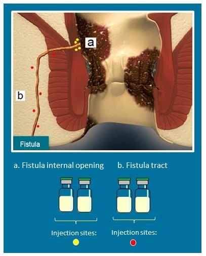 Background Crohn s disease (CD) is complicated by perianal fistulas in 30 50% of patients 1 Perianal fistulas in Crohn s disease are difficult to treat with currently available therapies and often