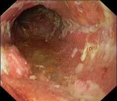 associated with abscess, rectovaginal fistula