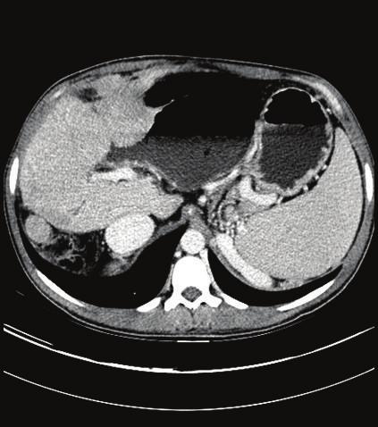 Case Reports in Pathology 3 (a) (b) (c) (d) (e) Figure 2: (a) CT scan of liver. (b) Gross picture showing nodular surface with somewhat exophytic mass on right.