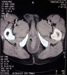 Evaluation - Imaging Fistulography CT U/S MRI <25% accuracy abscess assess sphincters 86%