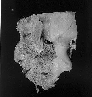 TM JOINT ANKYLOSIS MITARASHI ET AL. Results of Examination The external appearance of the cadaver presented as a striking example of a chinless deformity with a bird-like (parrot-like) facial profile.