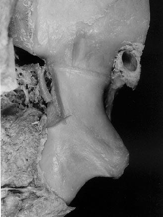 The left temporomandibular joint (affected side) (Figures 1-3) was immobilized by gross osseous ankylosis extending from the condyle to the mandibular angle and the antegonal notch area and had