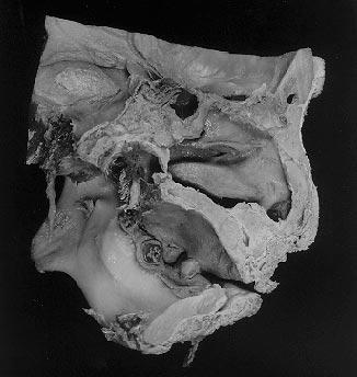 The antegonal notch was unusually large, and the masseter muscle was smaller than normal with a thickness of only 7.3 mm.
