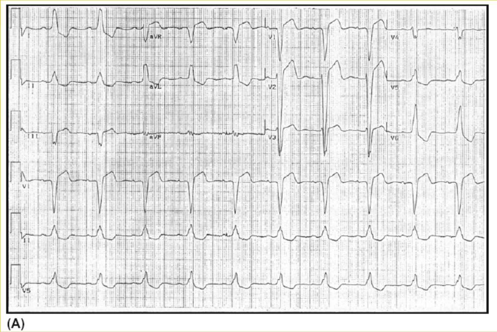 Heart Failure Left BBB, with QRS duration of