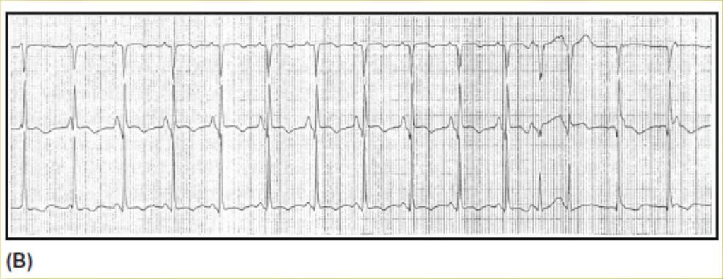 Premature Beats Two junctional beats, followed by nine sinus beats and then two premature junctional beats.