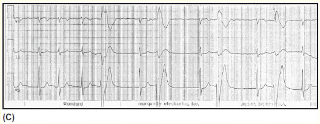 A premature junctional beat can be identified by the change in heart rate and the lack of an associated P wave.