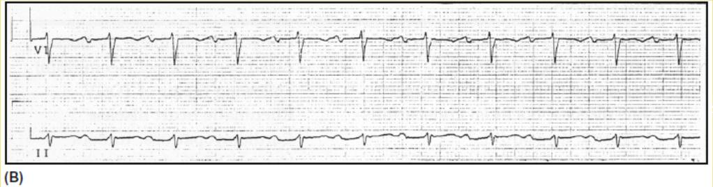 Heart Blocks First-degree (1 ) AV block.