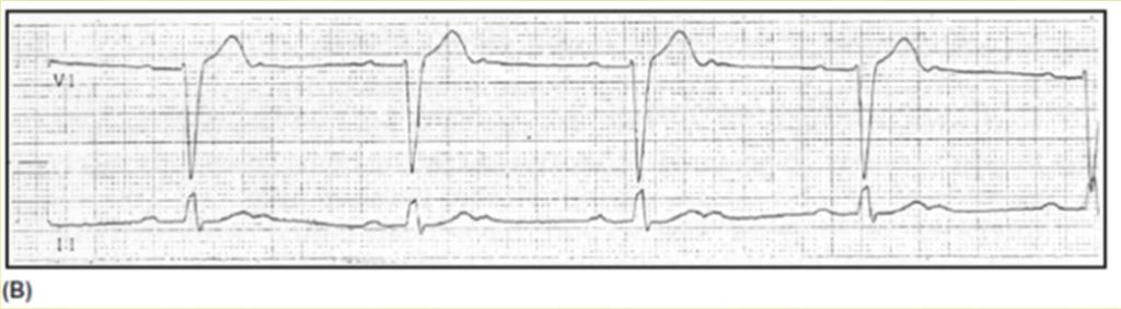 Heart Blocks Type II (Mobitz II) 2 AV block, the P-R interval remains consistent, but a QRS complex does not follow every P wave. Two to four P waves may occur before ventricular.