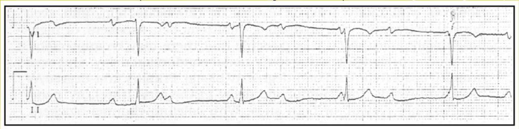 Heart Blocks Ventricular third-degree AV block, or complete AV block, The atrial rate becomes completely dissociated from the ventricular rate, or R-R interval.