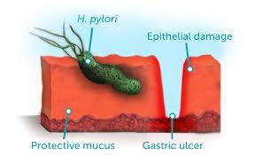 H pylori and PUD 70% of PUD occurs in people with H pylori 5-10% of those