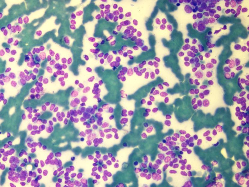 ZOLLINGER-ELLISON SYNDROME FIG. 3: Abundant discrete round monomorphic cells in the fine needle aspiration cytology smear of the pancreatic space-occupying lesion indicative of a neuroendocrine tumor.