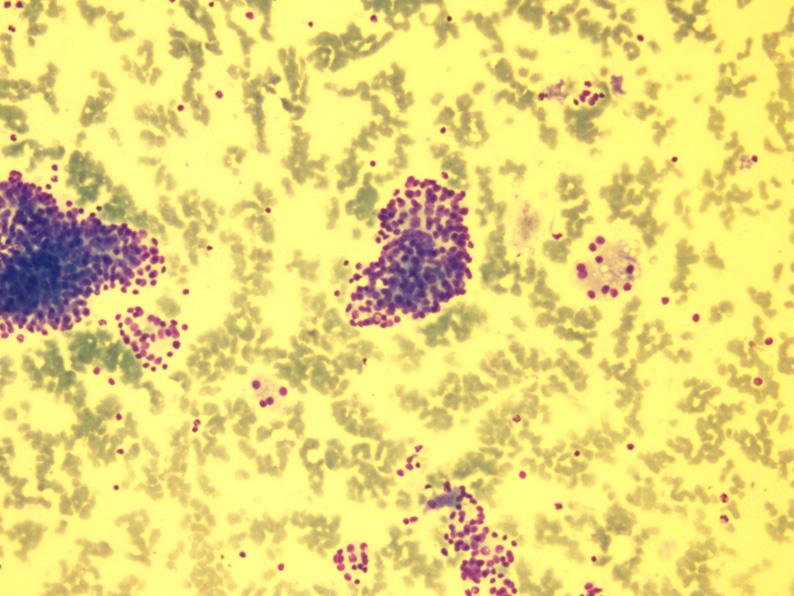 The immunocytochemical stain for chromogranin on FNAC smears was positive. A clinical diagnosis of ZES with primary in the pancreas and multiple liver and lymph nodal metastasis was finally concluded.
