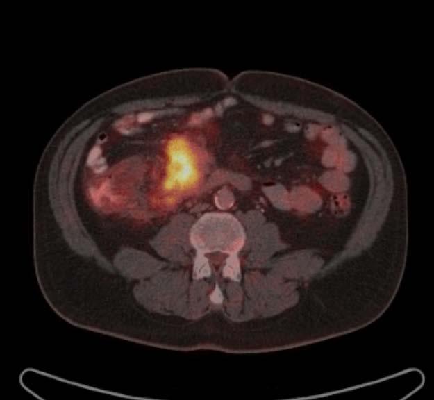 Case SiNET Tumour