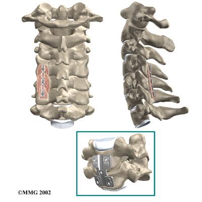 Metal plates and screws are generally used to hold the spine in place while it heals. A corpectomy is used in cases of severe spinal stenosis and myelopathy.