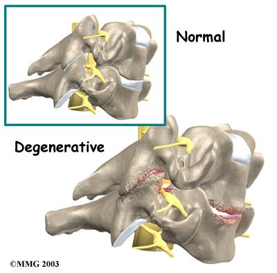 Degenerative Disc Disease The normal aging process involves changes within the intervertebral discs. Repeated stresses and strains weaken the connective tissues that make up a disc.