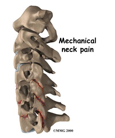 through the neural foramina. This pressure around the irritated nerve roots can cause pain, numbness, and weakness in the neck, arms, and hands.