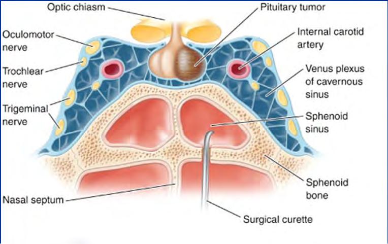 Aims: Treatment To correct hypersecretion of anterior pituitary hormones To preserve normal secretion of