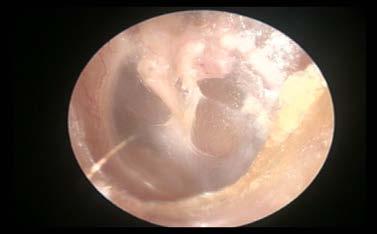 Examination revealed normal bilateral pinna and ear canal.