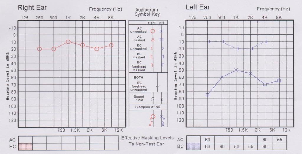 Figure 3: Pure Tone Audiogram showed left conductive hearing loss with air-bone gap (ABG) of 30-50dB Further investigation was performed with High Resolution Computed Tomography (HRCT) of temporal