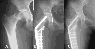 yrs) Femoral Neck Stress Fractures/Injury (FNSF) Are wickedly