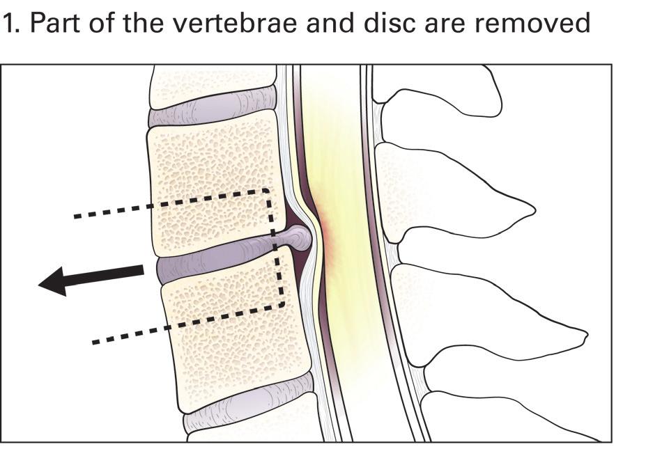Surgery Surgery is used to treat DCM in patients with spinal cord