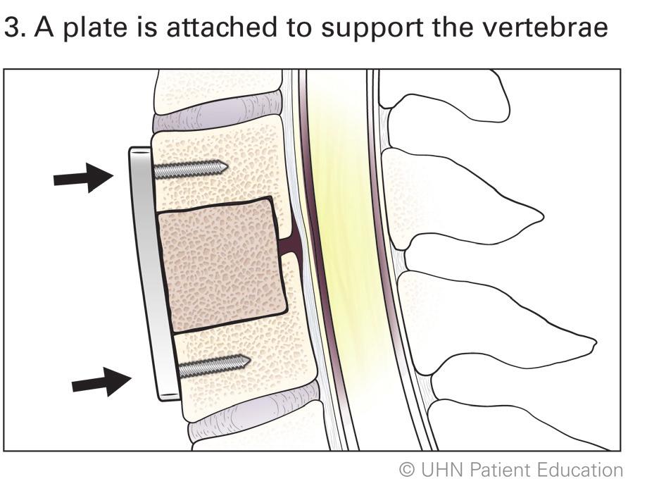 vertebrae is partially removed and replaced with bone or synthetic