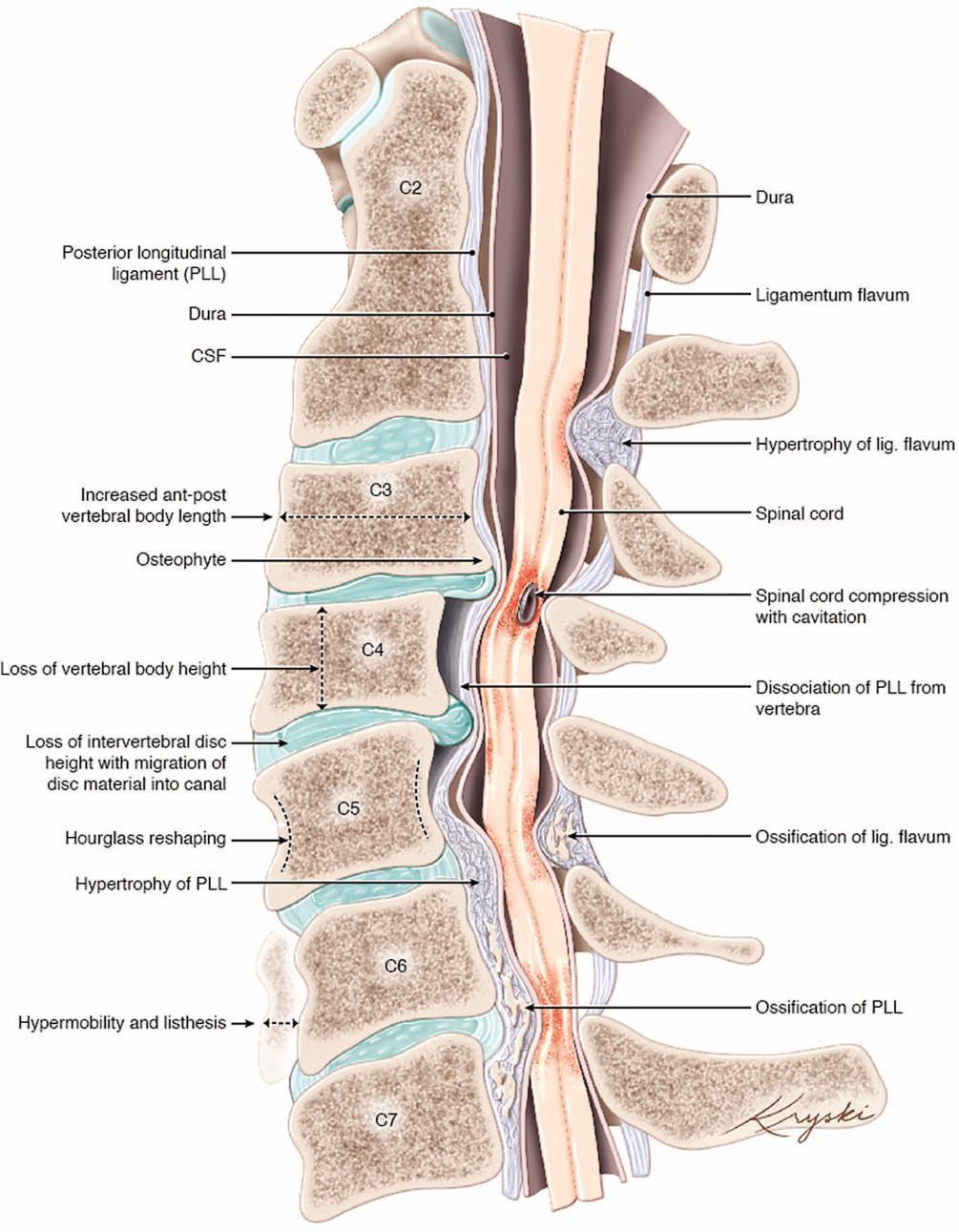 What DCM does to the spinal cord Ligament Dura Cerebrospinal fluid Increased vertebral body length Osteophyte Shortened vertebral body height Loss of disc height with bulging into canal Bone