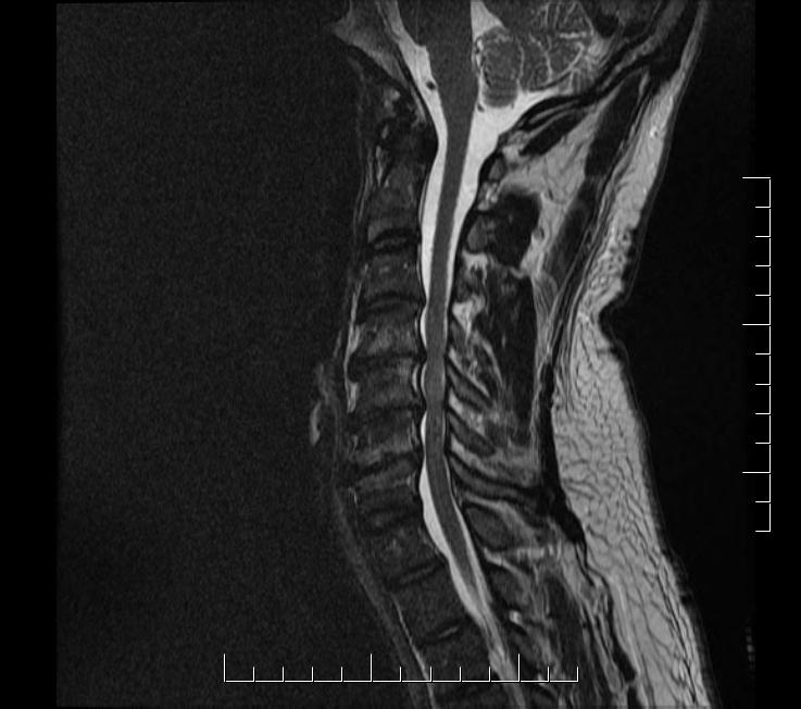 MRI showing DCM, as seen by the multi-level spinal cord compression and degenerative changes. MRI showing DCM, as seen by the disk degeneration with cord compression and cervical stenosis.