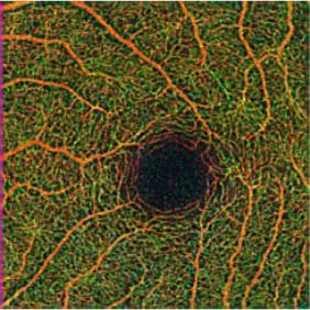 Full retina slab RETINAL SEGMENTATIONS Superficial Retina (ILM to IPL) Deep Retina IPL to OPL Avascular Retina Below OPL Color Depth Retinal Map can help you determine which section you need to look