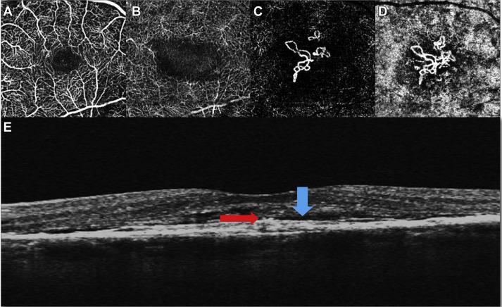 Sambhav et al 2017 AGE RELATED MACULAR DEGENERATION OCTA is great tool for monitoring Dry to Wet conversion Recognize subtle CNVM and get treatment promptly OCTA provides ability to visualize