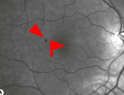 MACULAR TELANGIECTASIA A congenital or developmental vascular disorder Exudative dilations of perifoveal retinal capillaries Type 1:Aneurysmal Males,